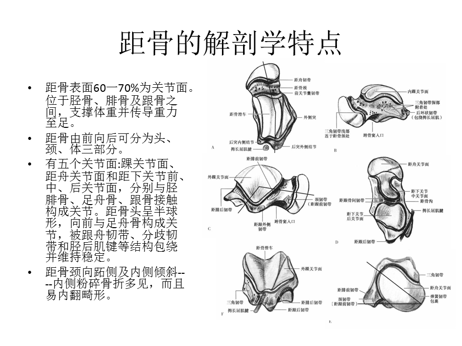 距骨骨折.ppt_第3页