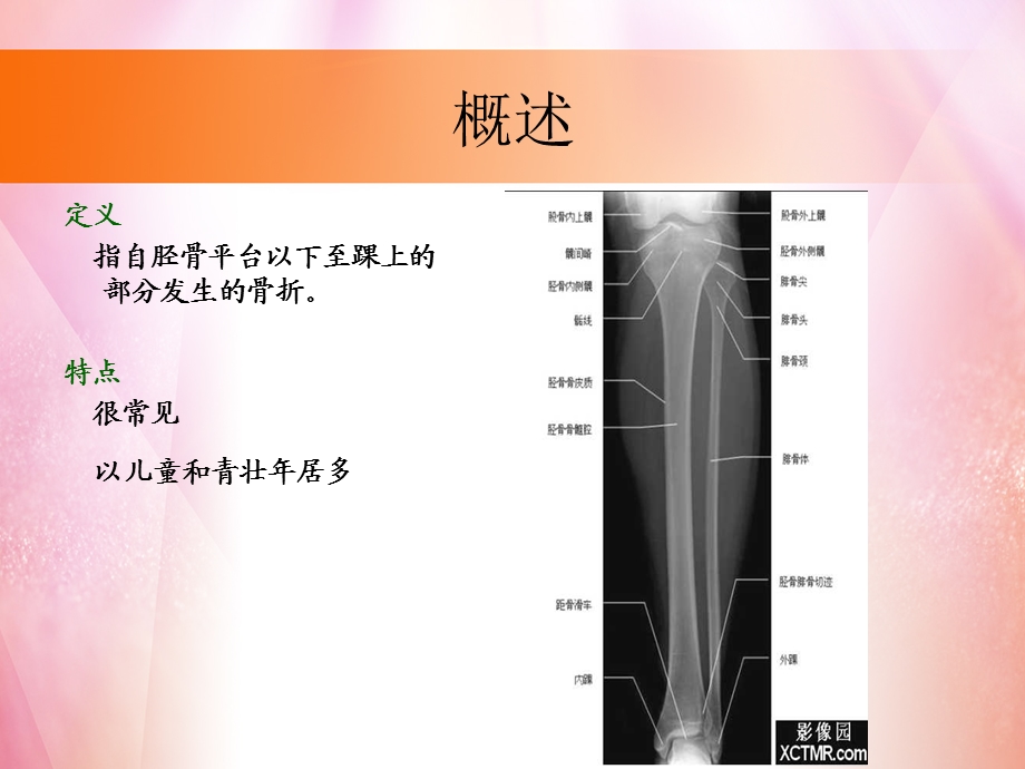 胫腓骨踝关节骨折专题培训PPT.ppt_第3页