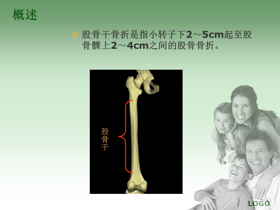 股骨干骨折的护理及功能锻炼.ppt_第2页