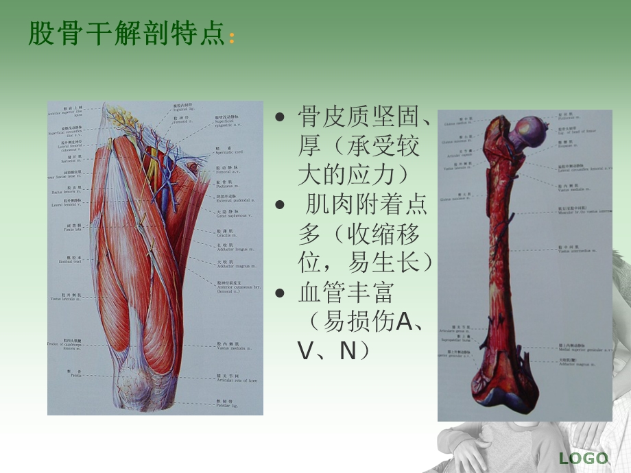 股骨干骨折的护理及功能锻炼.ppt_第3页