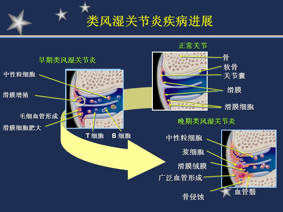 类风湿性关节炎的诊断治疗.ppt_第3页