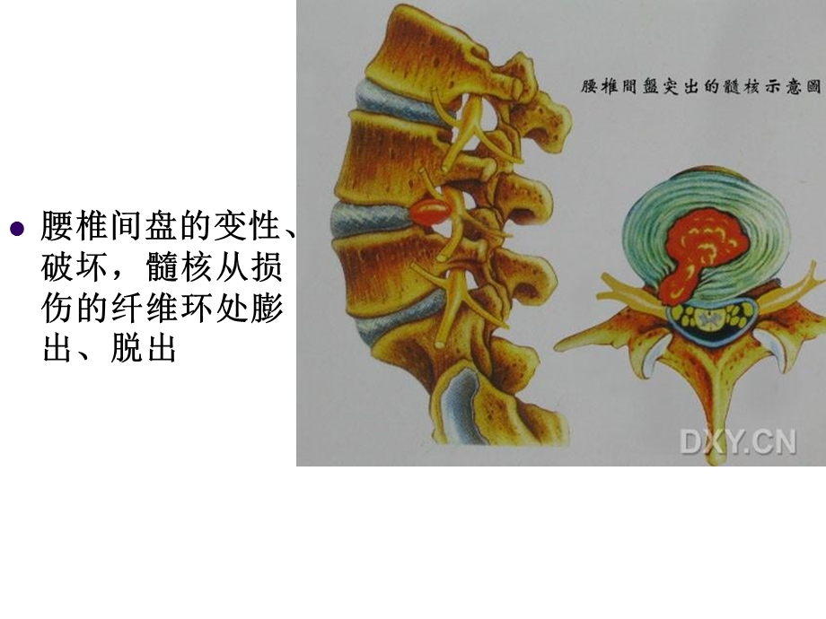 腰椎间盘突出症PPT幻灯片.ppt_第3页