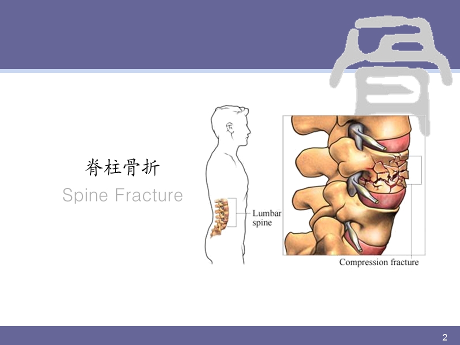 脊柱骨折.ppt_第2页