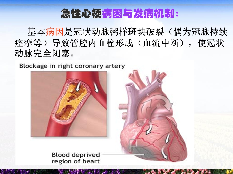 急性心梗溶栓的护理.ppt_第3页