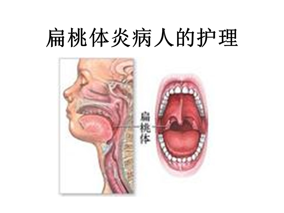 咽科病人的护理.ppt_第2页