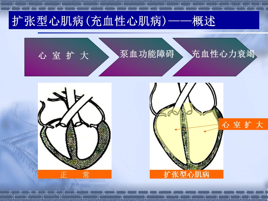 扩张型心肌病查房.ppt_第3页