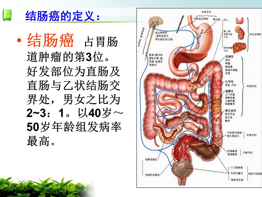 乙状结肠癌护理查房.ppt_第2页