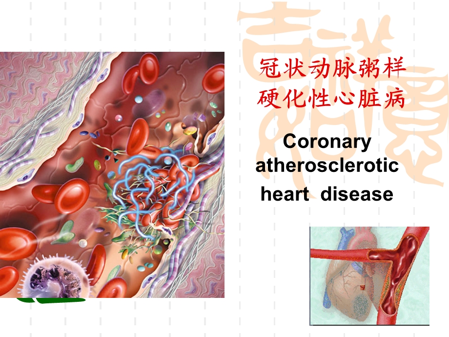 冠心病护理.ppt.ppt_第1页