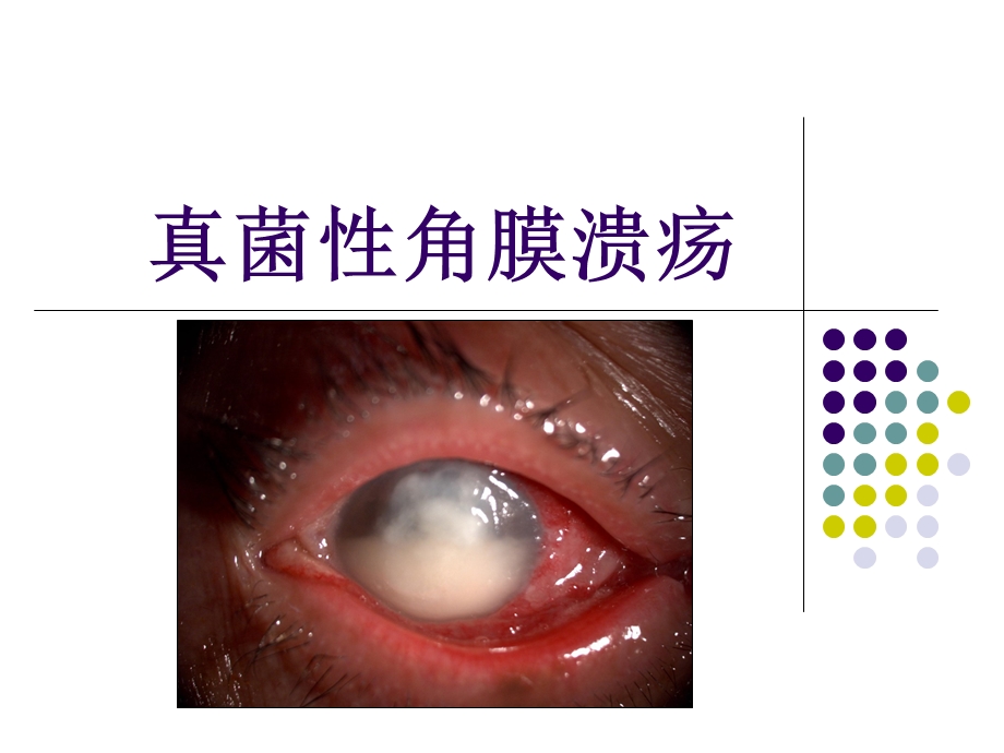 真菌性角膜炎.ppt_第1页