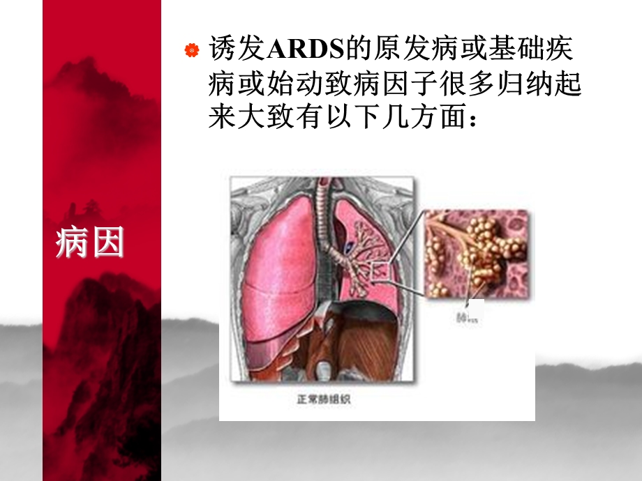 ARDS护理查房.ppt_第3页