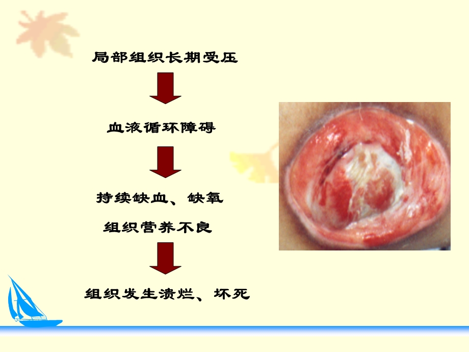 业务学习压疮预防及护理.ppt_第3页