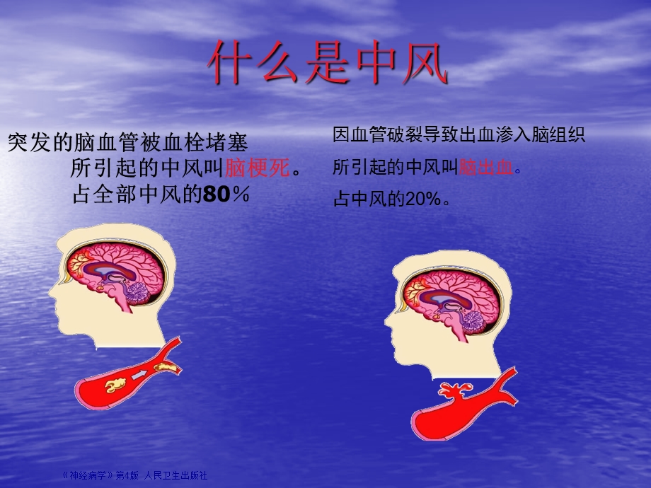 脑卒中护理查房.ppt_第2页