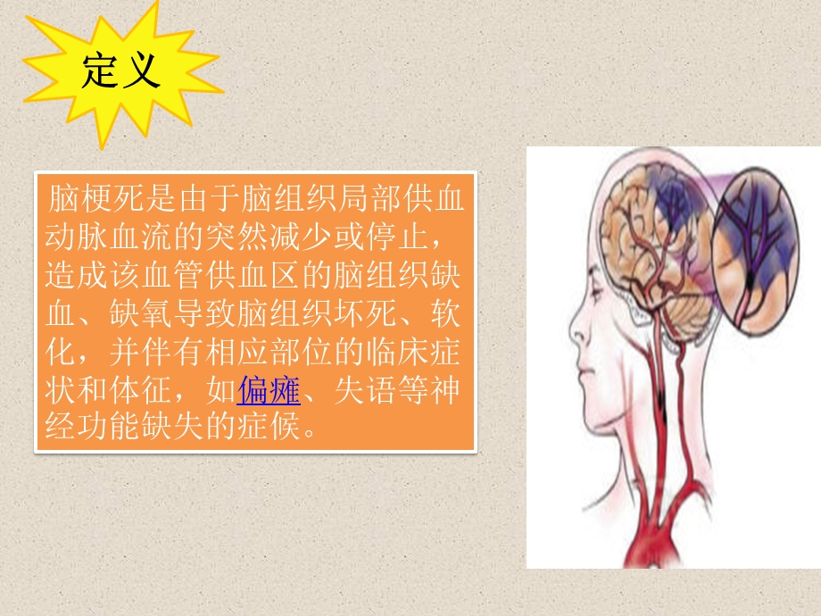 脑梗死的护理.ppt_第2页