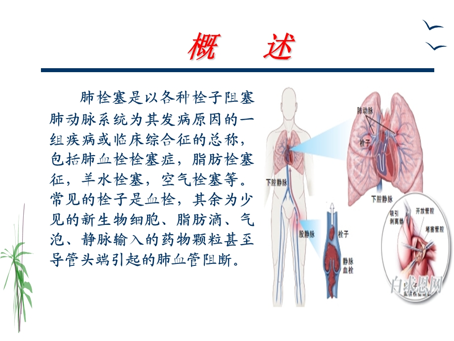 肺栓塞的治疗与护理.ppt_第2页