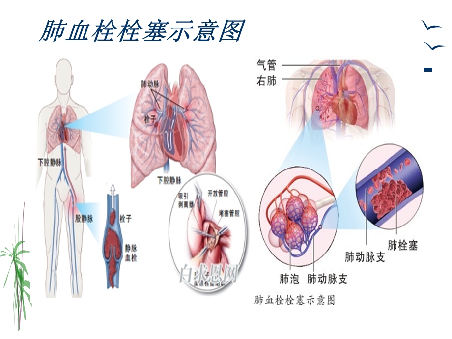 肺栓塞的治疗与护理.ppt_第3页