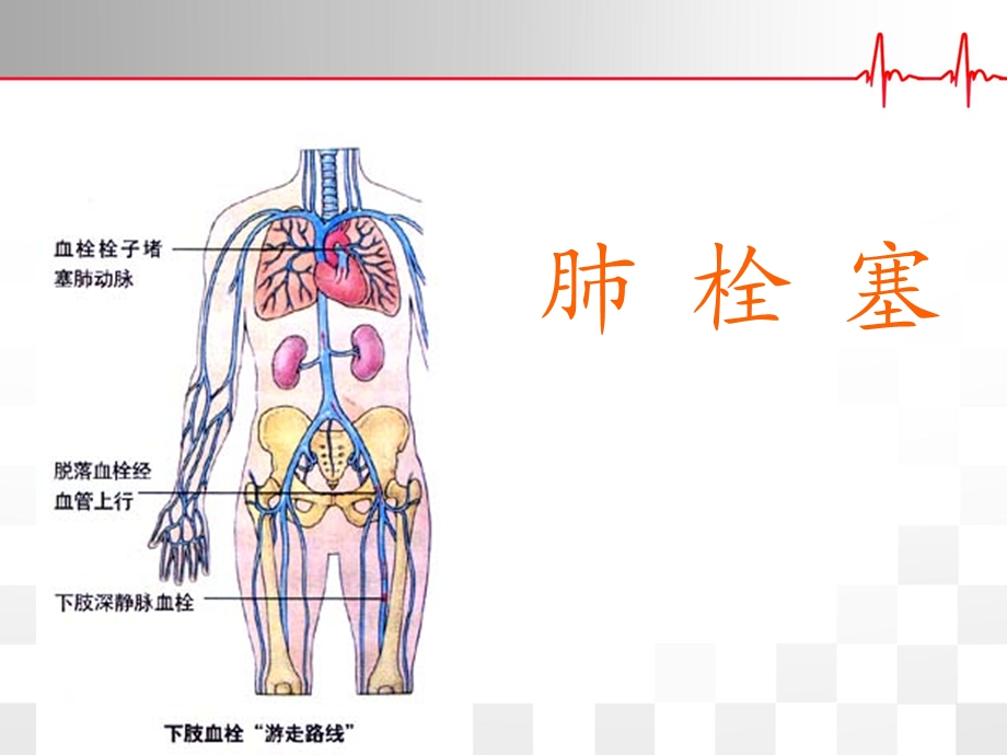 肺栓塞诊疗及护理.ppt_第1页