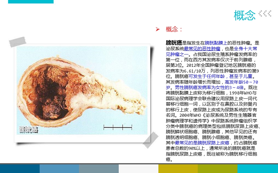 膀胱癌患者护理查房.ppt_第3页