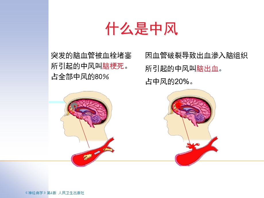 西医对脑中风识别及预防.ppt.ppt_第2页