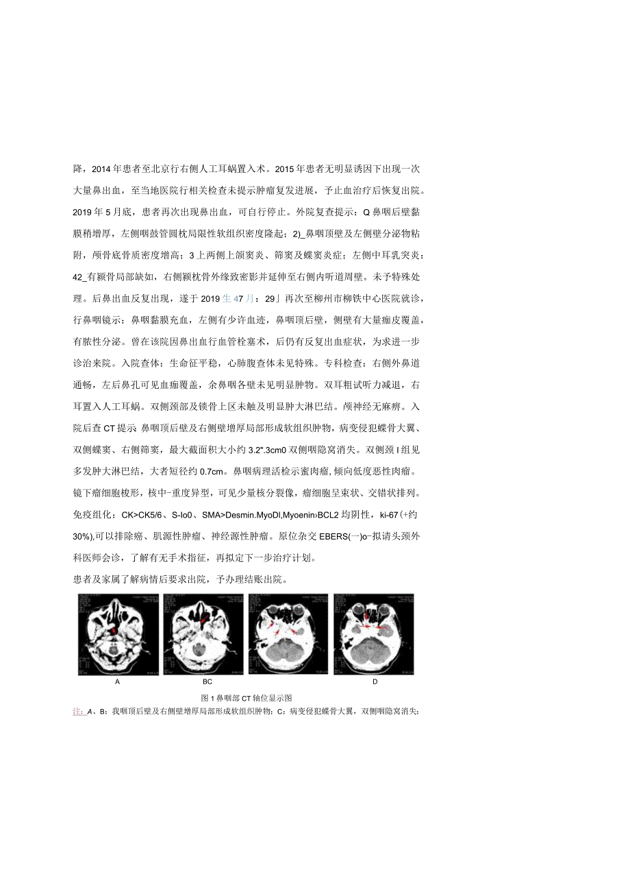 鼻咽癌放疗后诱发肉瘤一例并文献复习.docx_第2页