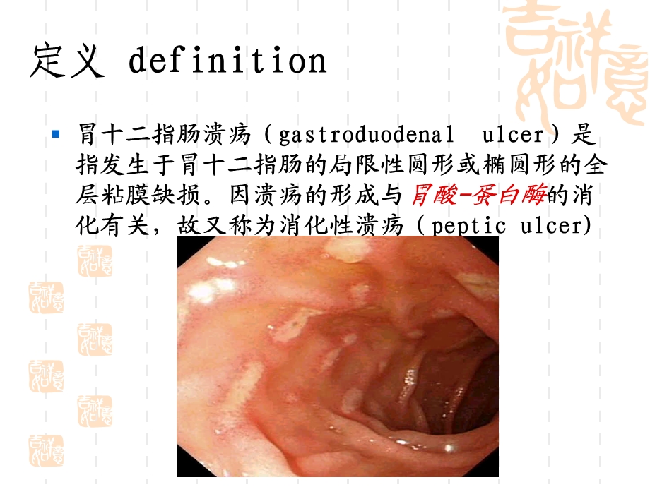 胃十二指肠溃疡.ppt_第2页