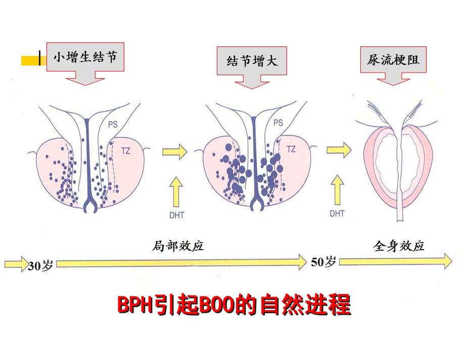 BPH临床进展性及其治疗策略.ppt_第2页