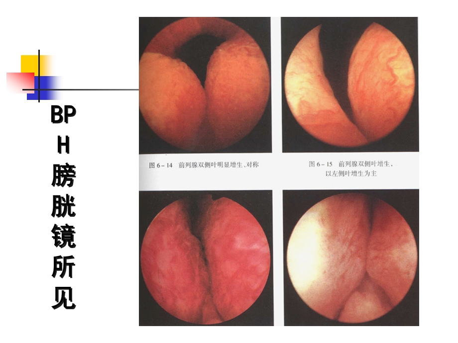 BPH临床进展性及其治疗策略.ppt_第3页