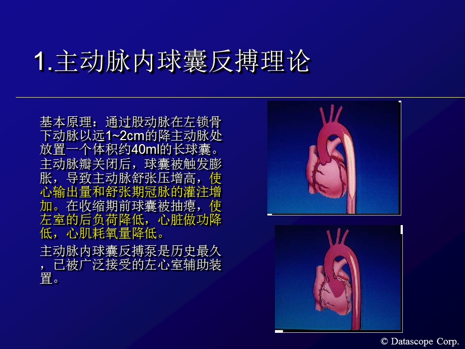 IABP主动脉内球囊反搏泵的临床使用.ppt_第2页