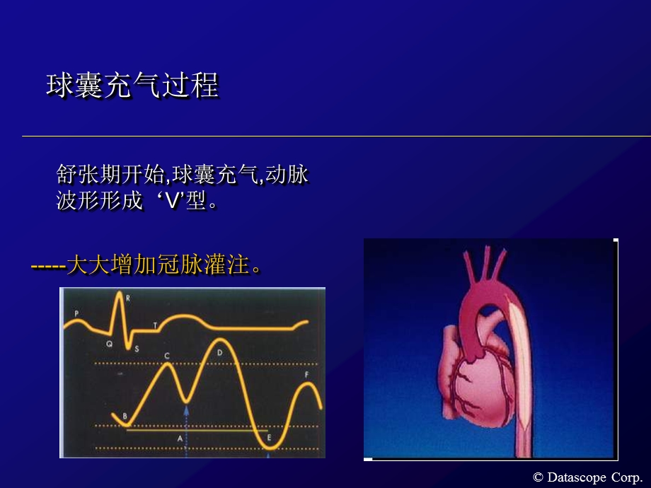 IABP主动脉内球囊反搏泵的临床使用.ppt_第3页