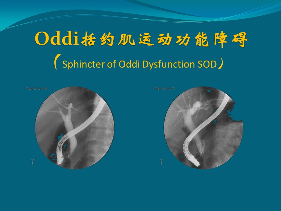 Oddi括约肌运动功能障碍.ppt_第1页