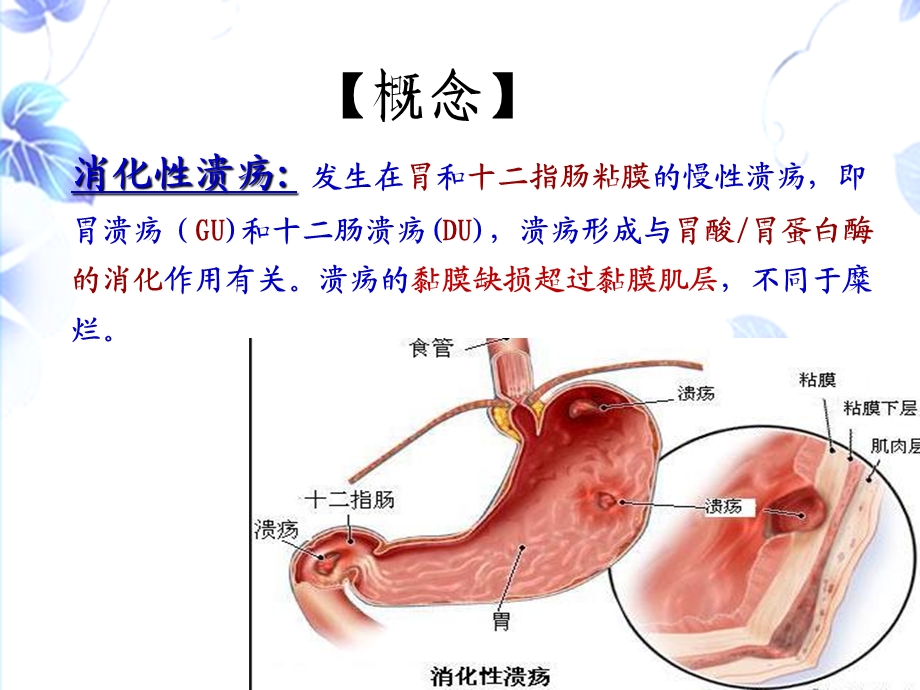 消化性溃疡的护理.ppt_第2页