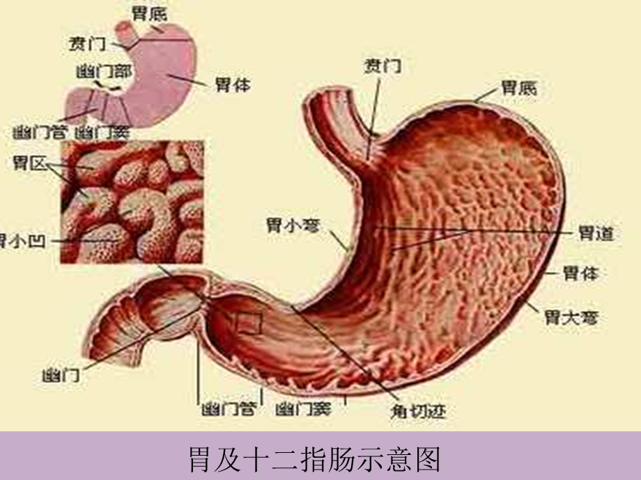 消化性溃疡的护理.ppt_第3页