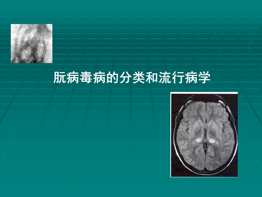 CJD临床诊断及监测.ppt_第3页