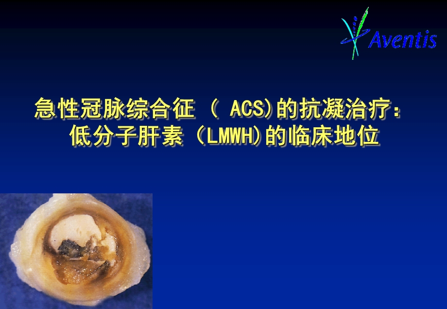 【精美医学课件】急性冠脉综合征(ACS)的抗凝治疗低分子肝素(LMWH)的临床地位.ppt_第1页