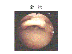 纤支镜的临床图谱.ppt