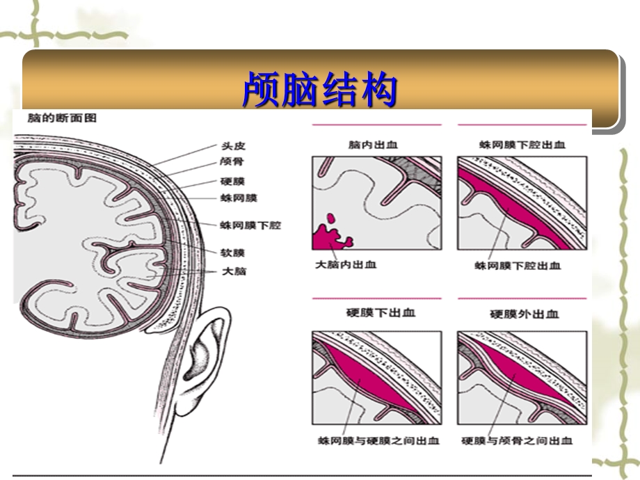 蛛网膜下腔出血的观察及护理.ppt_第2页