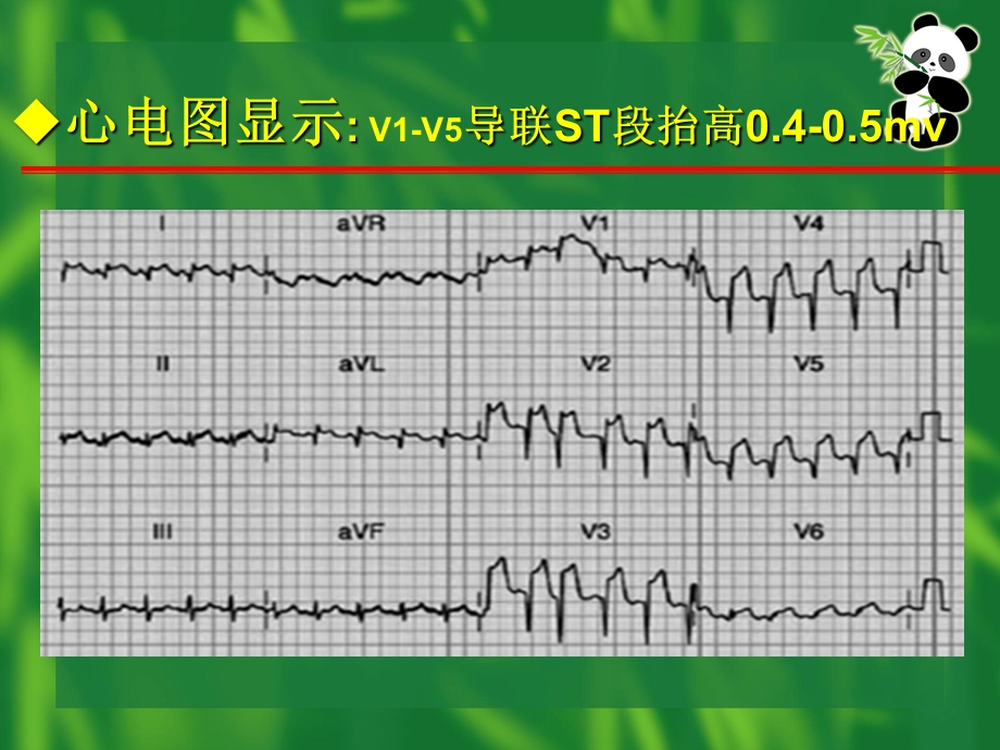 β受体阻滞剂临床应用病例分析.ppt_第3页