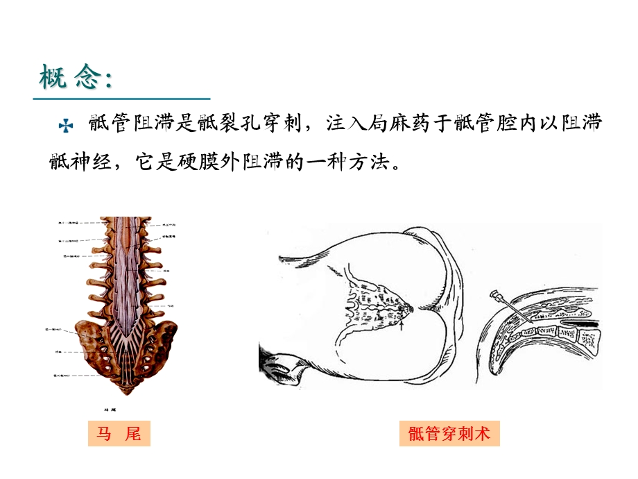 骶管麻醉PPT.ppt_第3页