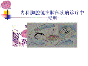 内科胸腔镜在肺部疾病诊疗中应用.ppt