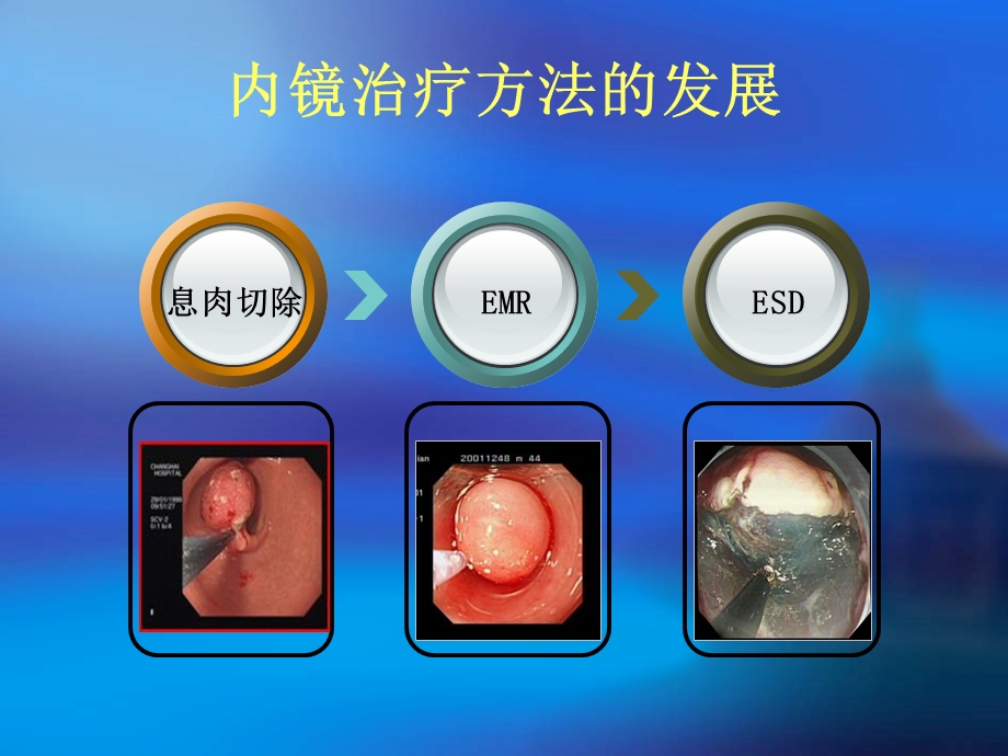 内镜下粘膜切除术.ppt_第2页