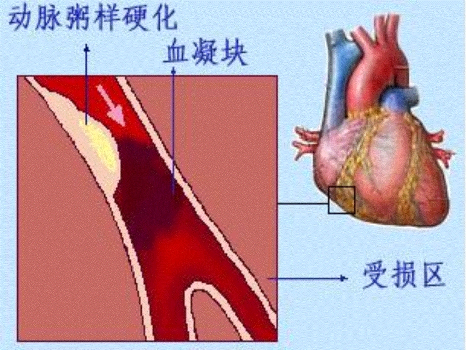 心肌梗死的防治.ppt_第3页