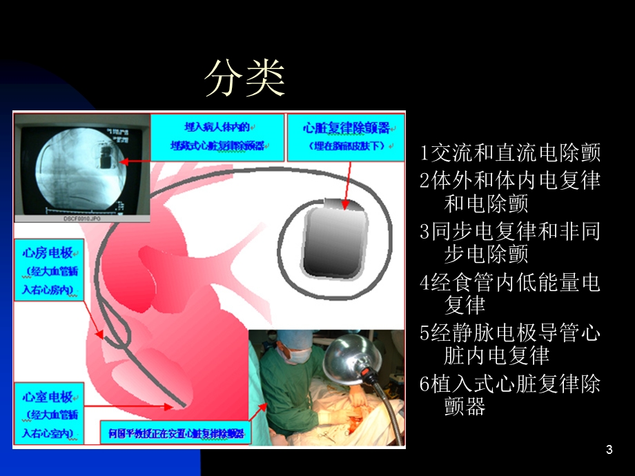 心脏电复律.ppt_第3页