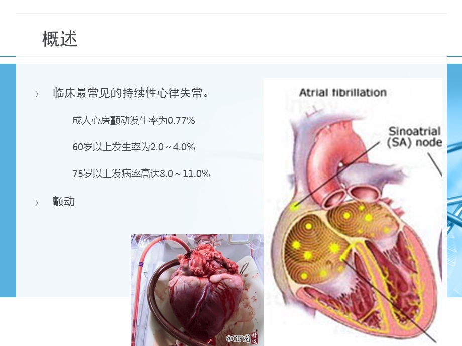 心房颤动ppt.ppt_第2页