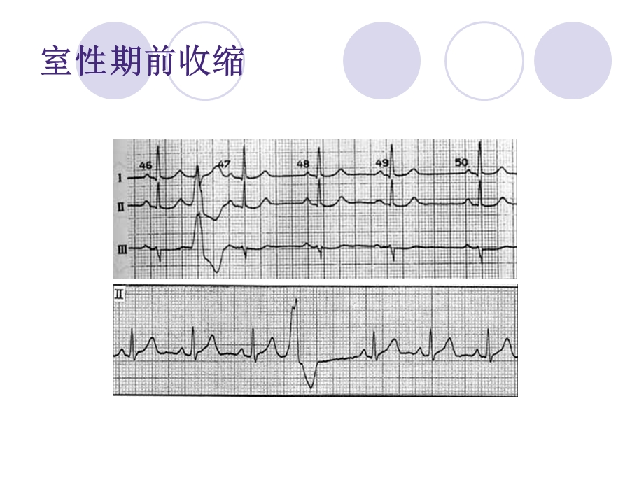 室性心律失常ppt.ppt_第3页