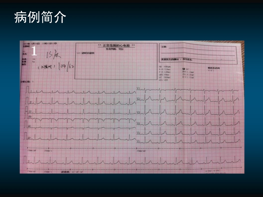 房缺合并左心室憩室一例.ppt_第3页