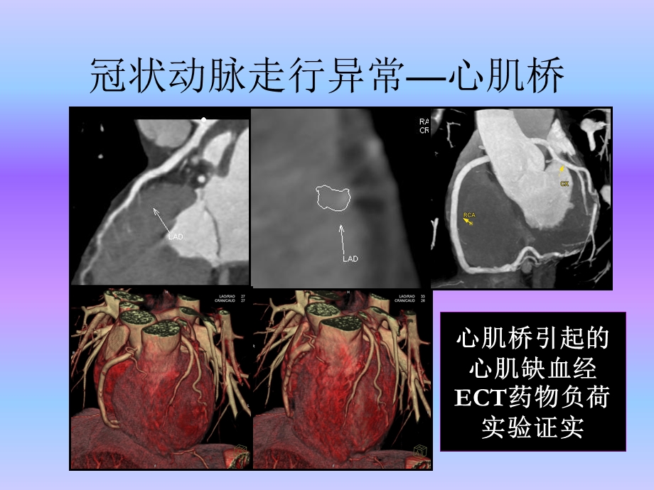 心血管疾病64层CTA诊断（三） .ppt_第1页