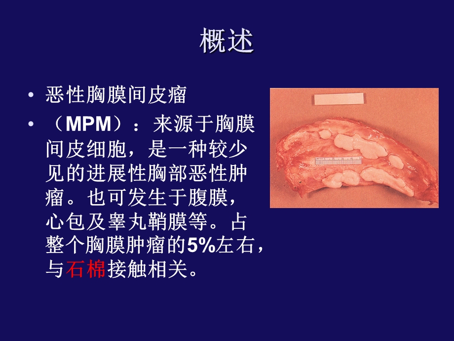 恶性胸膜间皮瘤诊治进展 华晶【ppt】 .ppt_第2页