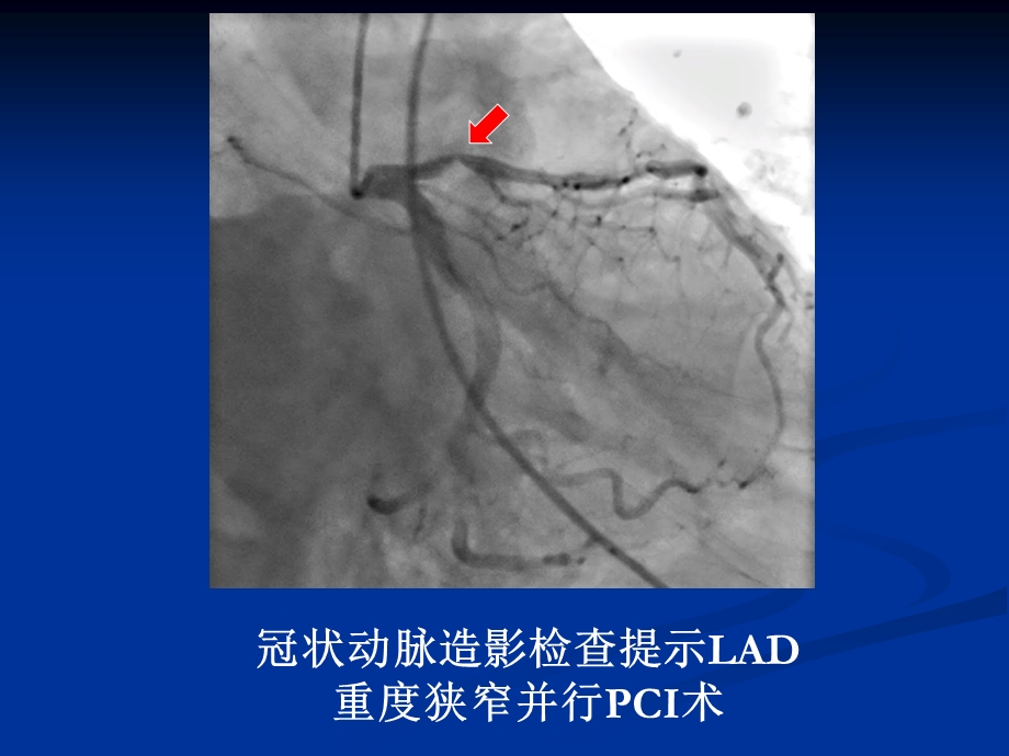 基因多态性与心血管疾病个体化用药.ppt_第3页