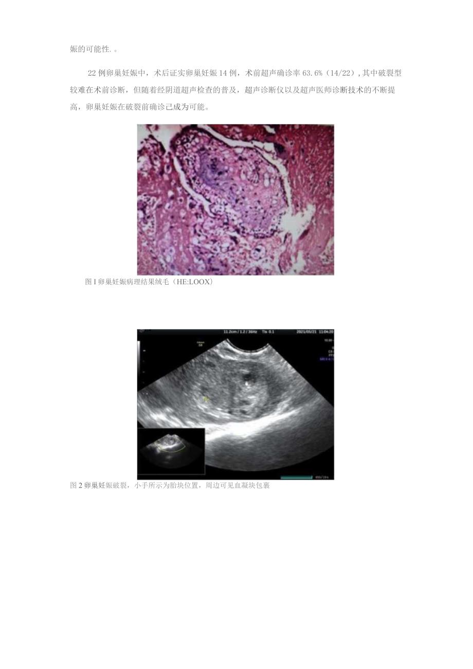 阴道超声在卵巢妊娠的临床应用价值.docx_第3页