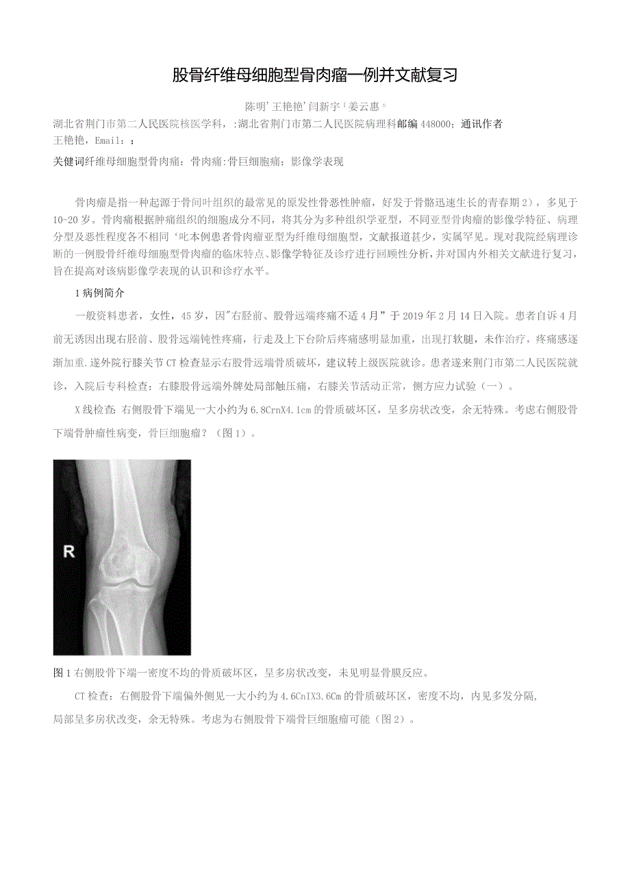 股骨纤维母细胞型骨肉瘤一例并文献复习.docx_第1页