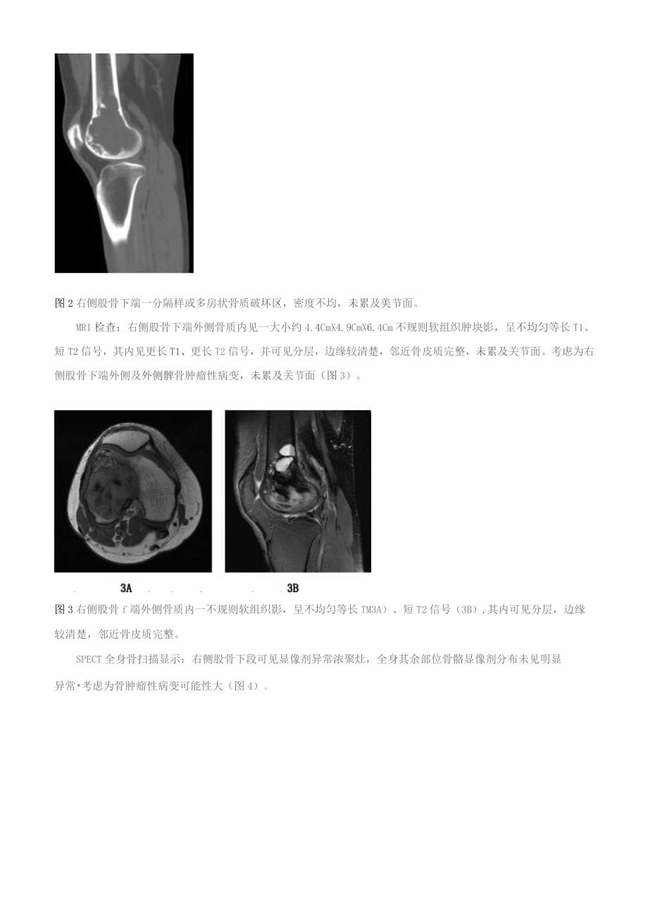 股骨纤维母细胞型骨肉瘤一例并文献复习.docx_第2页